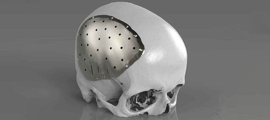 3D جمجمة مطبوعة